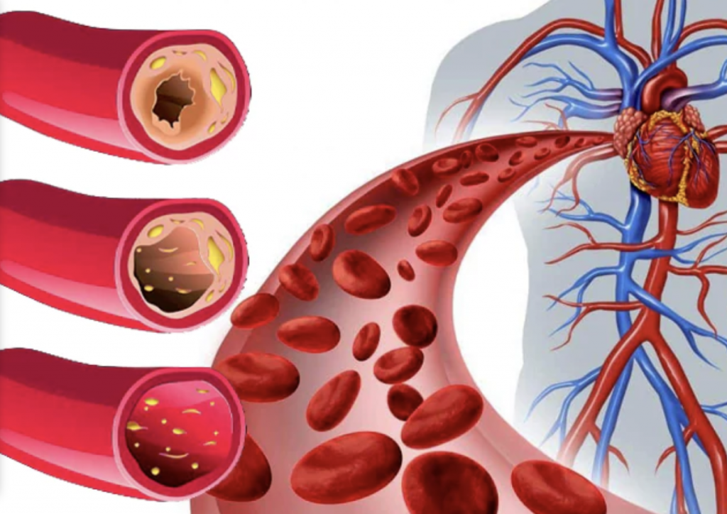 serrapeptase arteriosklerose