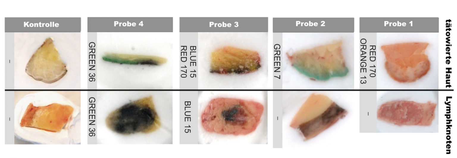 Tattoo Farbe in Lymphknoten